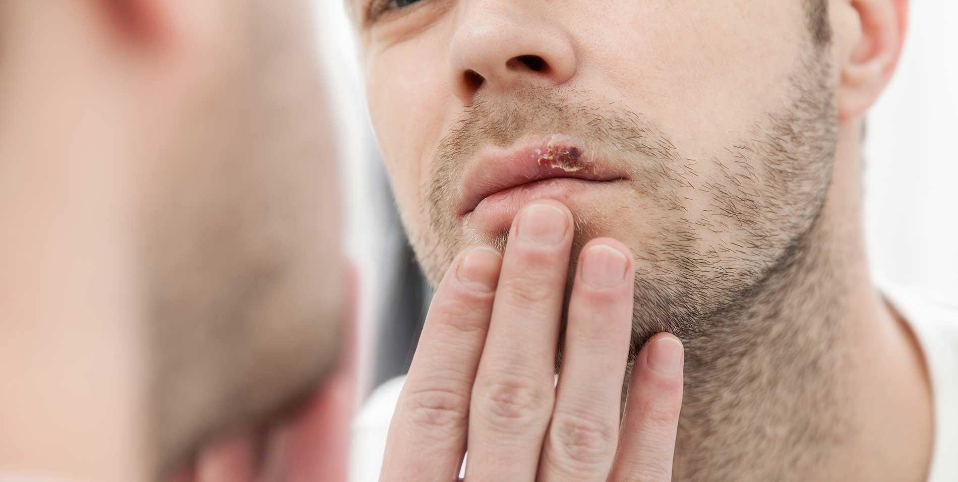 cold-sore-outbreaks